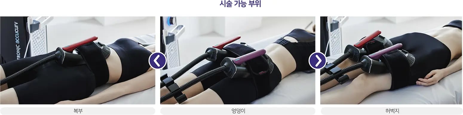 아큐커브 시술 부위
